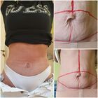 Grafika #0: Abdominoplastyka - galeria