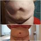 Grafika #3: Abdominoplastyka - galeria