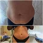 Grafika #2: Abdominoplastyka - galeria