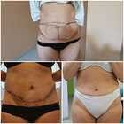 Grafika #1: Abdominoplastyka - galeria